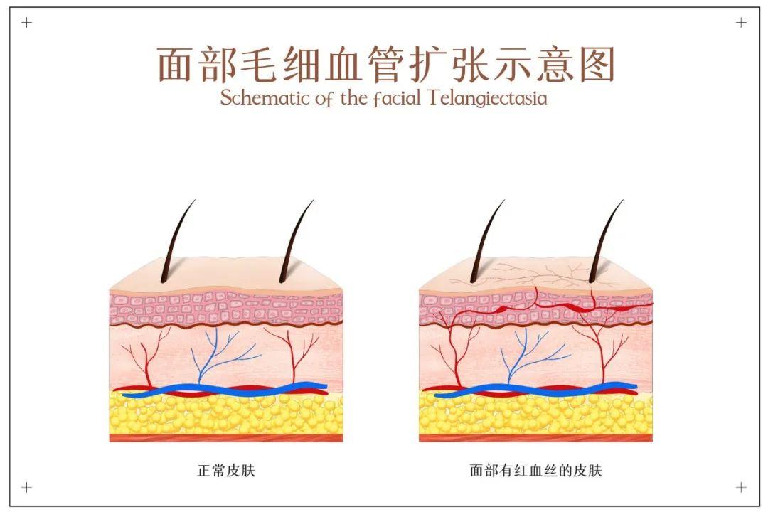 突发性过敏反应的家庭急救指南