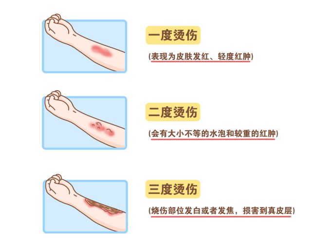 小面积烧烫伤伤口的急救处理指南